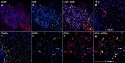 Immunohistochemical scoring of LAG-3 in conjunction with CD8 in the tumor microenvironment predicts response to immunotherapy in hepatocellular carcinoma